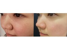 サナティオ(SANATIO)/全顔フルコース毛穴洗浄ハイドラ