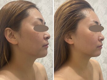 カプリス(CAPRiCE)/小顔フェイシャル