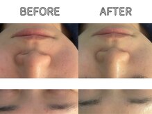 ライム 立川(LIME)/ハーブピーリング｜美白