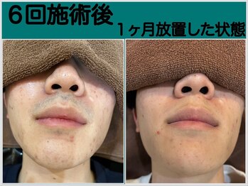 ファシネイト 新宿本店(Fascinate)/ヒゲ脱毛【メンズ脱毛/新宿】