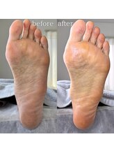 フットミー(foot mii)/カサつき解消