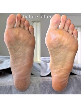 フットミー(foot mii)/カサつき解消