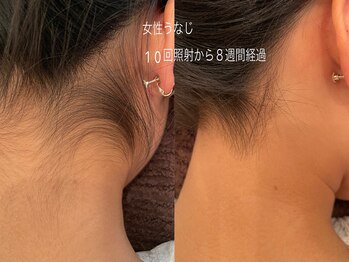 なちゅらる 苫小牧/うなじ脱毛