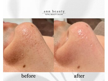 アン ビューティー(ann beauty)/施術1回【症例写真】20代男性