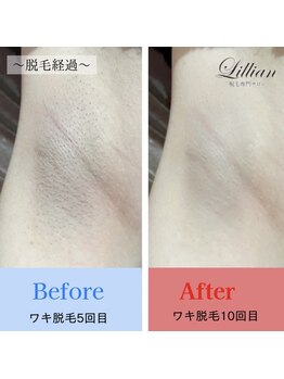 リリアン 周南店(Lillian)/ワキ before after