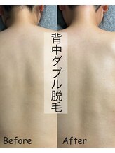 ジョエルワックス 沖縄糸満店(JOELLE WAX)/背中ダブル脱毛