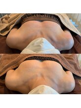 タオ(TAO)/バストアップ症例