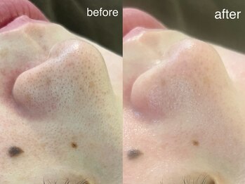 テオリア(TEORIA)/大人気!毛穴洗浄で黒ずみ撃退