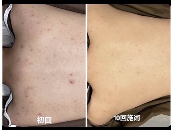 ヒジ(Life Salon)/背中ハーブピーリング