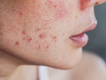 ラペカ(Lapeca)の写真/お顔ニキビに徹底アプローチ【REVIハーブピーリング＋選べる悩み別パック★¥8800】赤み・肌荒れ跡も改善！