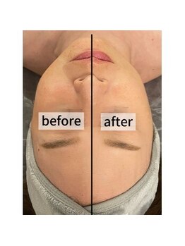 ディア(Deer)/韓国マイクロウェーブ×鍼灸