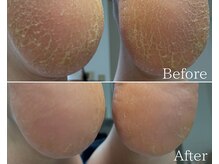 カシェット 広島店(Cachette)/40代女性☆足裏角質ケア90分