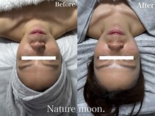 ナチュールムーン(Nature moon.)/ハーブピーリング