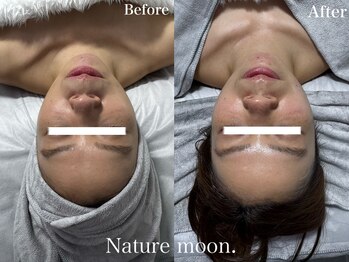 ナチュールムーン(Nature moon.)/ハーブピーリング