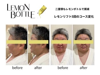 クリニカルエステ イーズ あべのキューズタウン店/FACEレモンボトル変化写真-3
