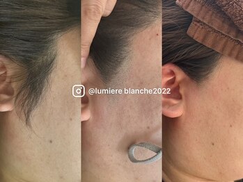 ルミエールブランシュ(Lumiere blanche)の写真/《つくば市/口コミ4・9》敏感肌にも優しい光脱毛☆2～3週に1度の光脱毛でムダ毛のお悩み最速解決◎