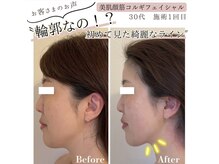 サロンニコ(salon Nico)の雰囲気（フェイスライン/食い縛り/リフトアップ/エラ張り/小顔/くすみ）