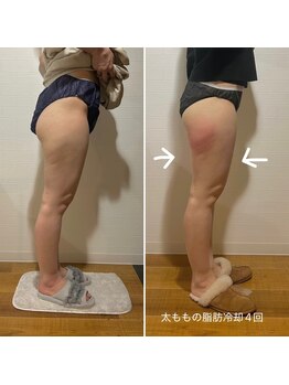 ルーチェエムベルシック(Luce.MBelChic)/太ももの脂肪冷却