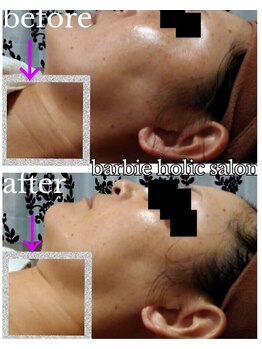 バービーホリック(barbie holic)/フェイシャルコース　施術前後