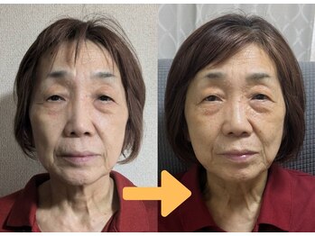 天使のしずく/諦めない！７０代のたるみ改善
