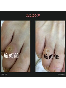 ドクターネイル爪革命 江戸川橋店/ここにできるたこって？！