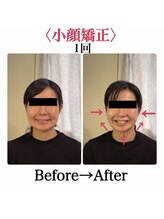 スターエステ(STAR ESTHE)/小顔矯正＋小顔ハイパーナイフ