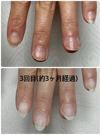 爪噛み　爪育成　実績多数