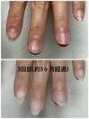 爪噛み 爪育成 実績多数