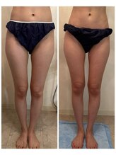 アプローズ(APPLAUSE)/インディバ美脚集中コース