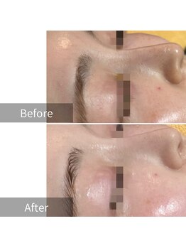 ヒヨリ(hiyori)/《before/after》毛穴洗浄