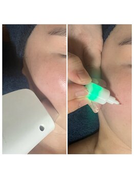 アドネ(Adone)/顔脱毛とシミケアが同時に可能!