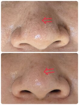 ボディキュア グランド(Body cure Grand)/毛穴の黒ずみ撃退