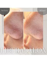 リベラサロン(LIBERA SALON)/毛穴のポツポツもスッキリ☆