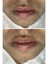 ヴィヴ 熊本(ViV)/髭脱毛5回目