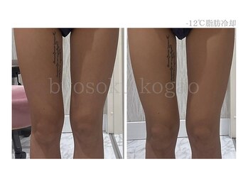 メディカルエステ 新宿南口店/*日本初-12℃脂肪冷却症例*