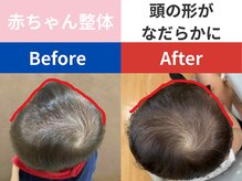 らくだ整骨院/赤ちゃんの頭の形が整う
