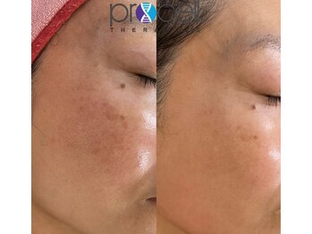 ルイース(LOUISE.)/プロセルセラピーズ肌質改善