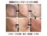 お顔・剥離ありハーブピーリング/ニキビ/毛穴/シミ/シワ ¥15,000