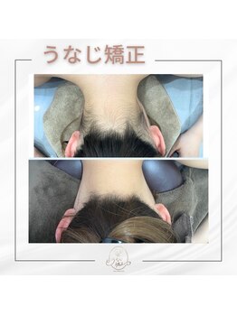 ミース 宮崎店/うなじ矯正の効果
