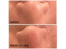 角栓浮き！しっかり洗浄していきます。施術後ツルツルに