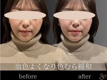 チョコバリ 恵比寿店(chocobari)/小顔リフトアップ（美容鍼）20代