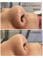 スウィート 矢場町店(Sweet)/【毛穴洗浄付顔脱毛】