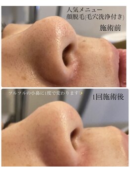 スウィート 矢場町店(Sweet)/【毛穴洗浄付顔脱毛】