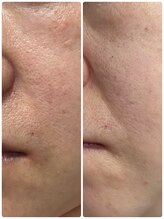 ヨサ パーク コアハート(YOSA PARK CORE HEART)/NMNフェイシャル