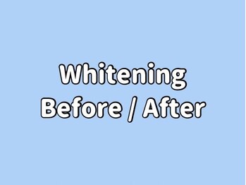 ホワイトニングカフェ 綾瀬店(WhiteningCafe)/◎歯のホワイトニング施術写真◎