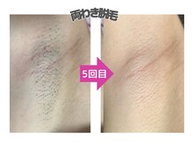 e脱毛屋さん 苫小牧店/中高生にも人気♪【両ワキ脱毛】