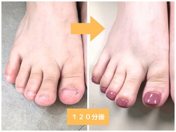 インブロッサム(imblossom)/フット深爪矯正