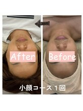 ナニワ ビューティー(naniwa beauty)/小顔WINBACK