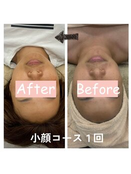 ナニワ ビューティー(naniwa beauty)/小顔WINBACK