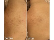 エミュ(emu)/ハーブケア &nbsp;お客様before/after